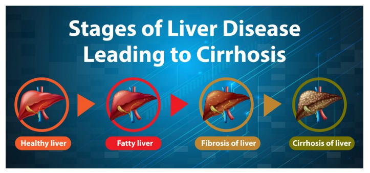 causes of fatty liver
