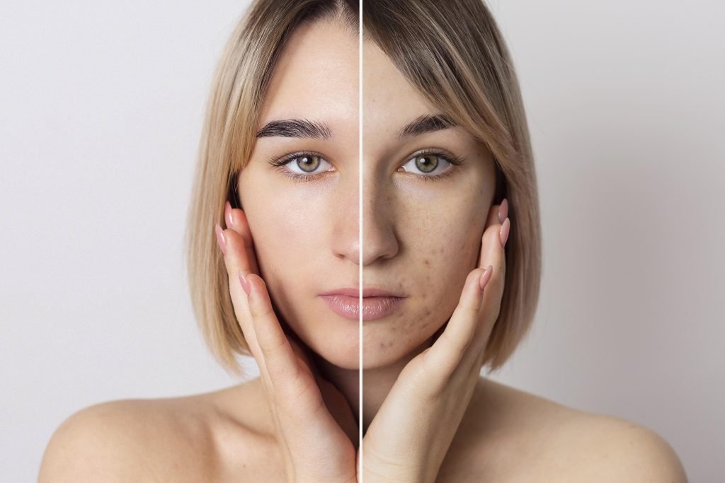 woman-with-acne-on-her-face-showcasing-her-natural-beauty-and-resilience-in-the-face-of-skin-challenges.jpg