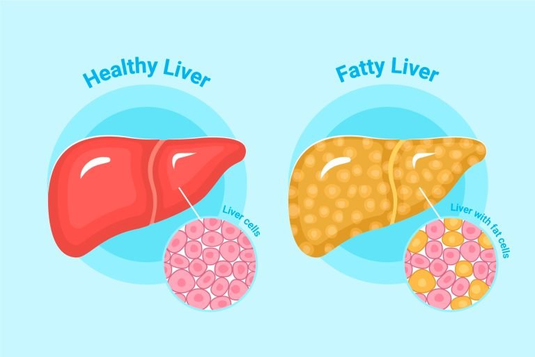 reverse-fatty-liver-disease-indore-lifestyle-tips-dr-archana-rathi